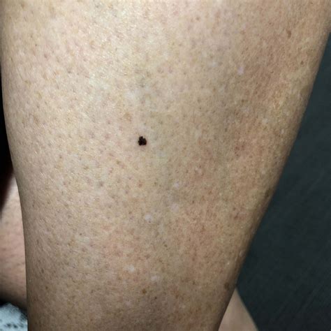 melanoma pictures on legs